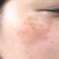 雷射祛斑對人的皮膚有副作用嗎-康泰美