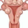 宮頸囊腫原來是這些原因導致，有這些症狀的女性需格外注意！