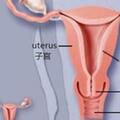 子宮內膜癌：了解症狀和治療 子宮內膜癌是一種常見的...
