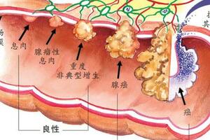 忽視一個細節，切了「息肉」也可能患癌……