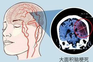 為啥中國腦梗死患者越來越多？廚房裡的3種調料濫用或是「幫凶」