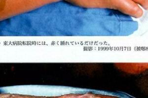 續命的代價：日本核輻射患者的83天煎熬