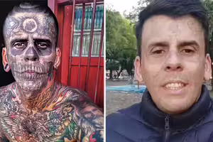 全身95%面積刺青！男為「找回尊嚴」忍痛3倍手術洗掉　重生模樣曝