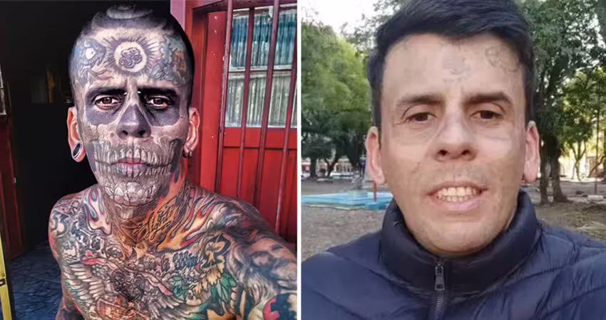 全身95%面積刺青！男為「找回尊嚴」忍痛3倍手術洗掉　重生模樣曝