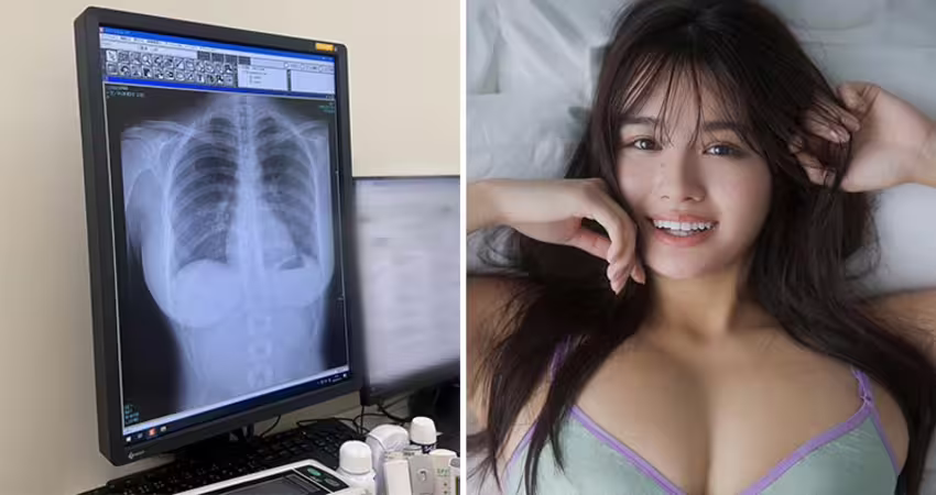 寫真偶像炫耀「我的肺很乾淨!」 網看X光全歪樓:太刺激了