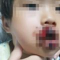 4歲女童被自家養土狗咬掉嘴唇家人憤怒將狗打死