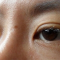 一覺醒來變成腫泡泡金魚眼！你有細細了解過眼睛浮腫的原因嗎？