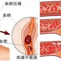 「腦中風」前會有 6 個徵兆！下一秒可能就天人永隔...為了家人，你一定要知道！