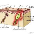 痘痘總是反覆長？你可能連長痘的原因都沒搞明白……