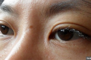 一覺醒來變成腫泡泡金魚眼！你有細細了解過眼睛浮腫的原因嗎？