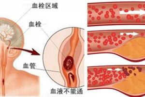 「腦中風」前會有 6 個徵兆！下一秒可能就天人永隔...為了家人，你一定要知道！