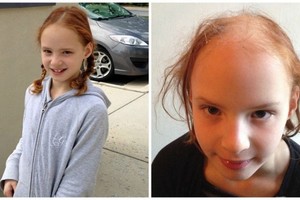 以為罹患癌症，女童用了它，僅3次之後頭髮竟掉光光！