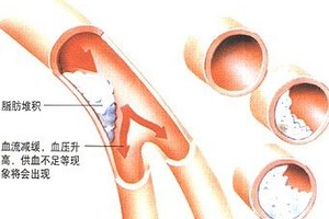 凈化血液的「完美食品」逆轉血管硬化