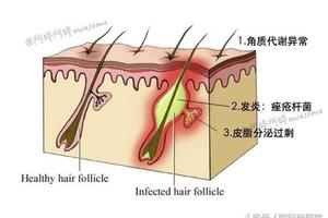 痘痘總是反覆長？你可能連長痘的原因都沒搞明白……