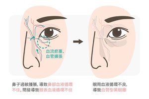 警惕！黑眼圈不僅是睡眠不足，還有可能是腎病來襲！