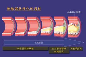 積極治療膽固醇 遠離冠心病及心肌梗塞