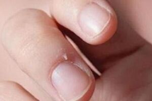 冬天手指周圍總是長倒刺，是不是缺乏維生素？最需要注意的是護膚