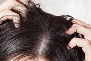 冬天頭皮屑多、頭皮發癢，勤洗頭髮也不管用？補充一種營養素
