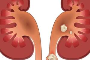 體檢查出腎結石，別慌：3個方法，或能讓腎結石離開身體