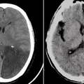 40歲年輕小伙出現腦梗，危害巨大！我們應該如何預防腦梗？