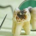 牙齒越少，死得越早？60歲後，牙齒剩多少顆才正常？看看你合格沒