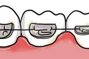 【口腔健康系列科普】牙齒矯正之口腔護理