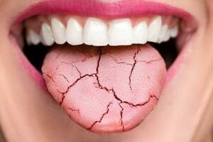 舌中有裂紋 病因多在脾 出現裂紋舌的四種原因 一文講清 學會受益一生