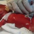 世界上胎齡最小男嬰，剛出生就破了世界紀錄，可謂生命力頑強！