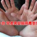 再奪一命中部早產男嬰腸病毒重症死亡~~5歲以下嬰幼兒為重症高危險群