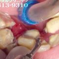 25歲女孩害怕牙醫「口腔嚴重石化」　洗牙影片療癒度破表