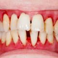 每天都刷牙為什麼還長牙石？形成薄膜，細菌、食物殘渣和脫落
