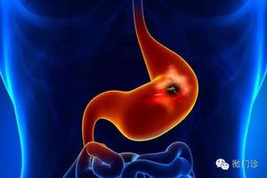 胃潰瘍為什麼總是反覆發作？「這10大因素」你可能沒注意過，千萬不要再忽視了！！
