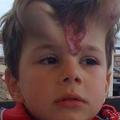 額頭天生有鮮紅胎記…　小男孩為了治療竟長出「惡魔角」　手術切除後巨大反差帥爆